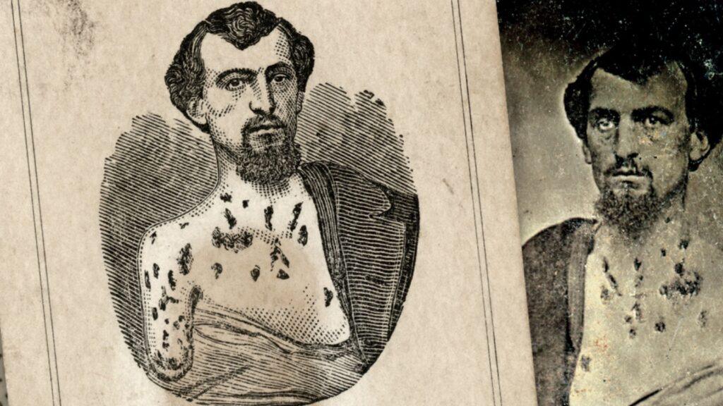 Раненый солдат Гражданской войны США с множественными шрамами на груди, 48 ранений, историческое фото и гравюра тяжело раненого бойца, Жак Рёллингер медицинский осмотр 1875 Medical Record